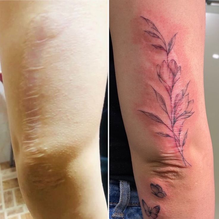 SCAR COVER-UP example 4