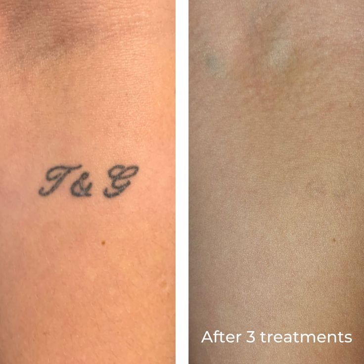 TATTOO REMOVAL example 3