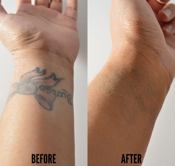 TATTOO REMOVAL example 4
