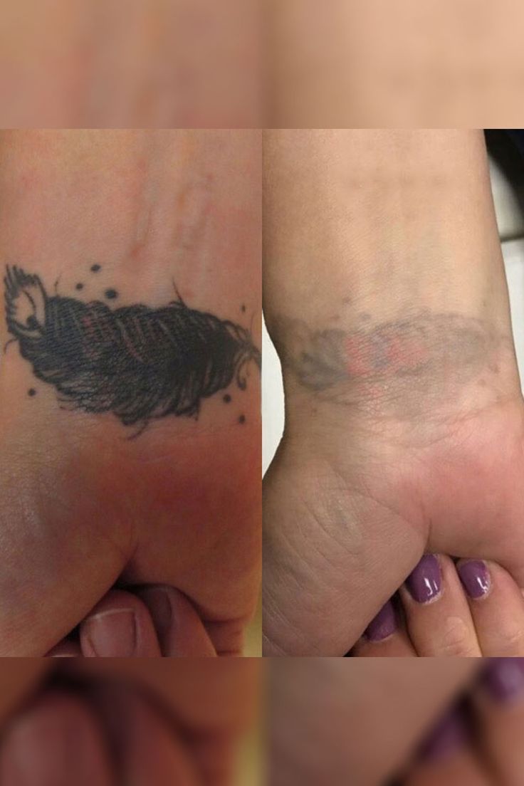 TATTOO REMOVAL example 5