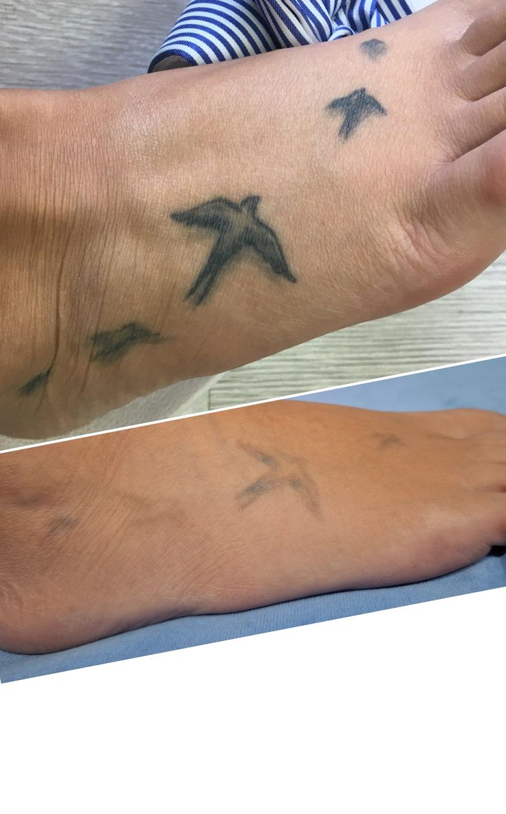 TATTOO REMOVAL example 7